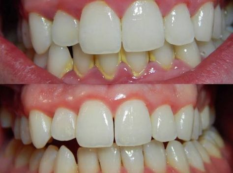 Dişçiye Gitmeden Diş Taşlarından Kurtulmanın Yöntemi